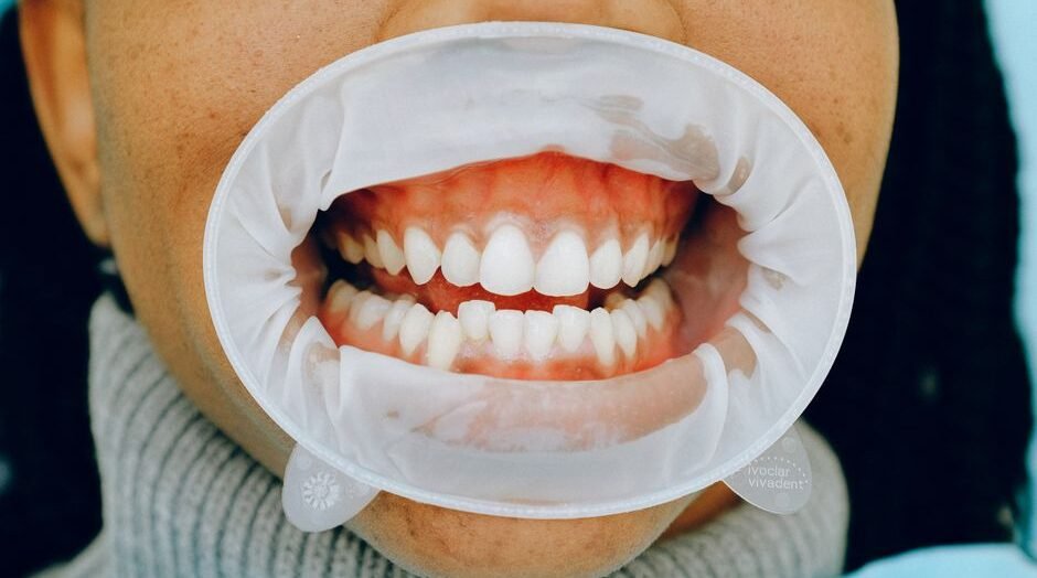Understanding the Basics of Gum Disease Prevention